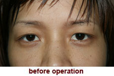 plastic-surgery-blepharoplasty